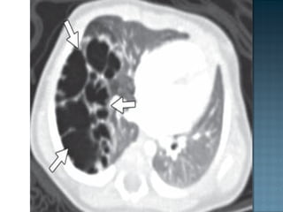  Es una afección congénita
 La misma frecuencia en ambos pulmones.
 AGENESIA - Ausencia total del pulmón,
bronquio y ar...