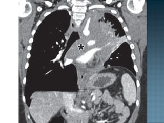 Hiperlucencia pulmonar bilateral Radiologia