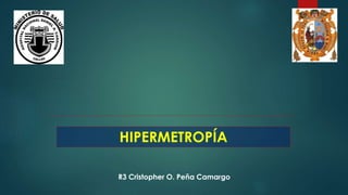 R3 Cristopher O. Peña Camargo
HIPERMETROPÍA
 