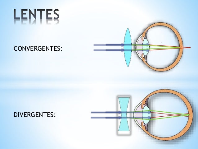 Lentes Convergentes Ou Divergentes Para Miopia: Guía Completa – GCXI