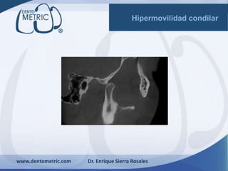 www.dentometric.com Dr. Enrique Sierra Rosales
Hipermovilidad condilar
 