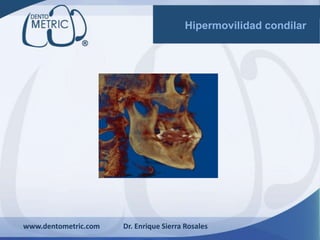 www.dentometric.com Dr. Enrique Sierra Rosales
Hipermovilidad condilar
 