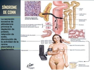 La secreción
excesiva de
aldosterona
provoca la
depleción de
potasio,
retención de
sodio,
disminución de
la actividad de la
renina
plasmática e
hipertensión.
 