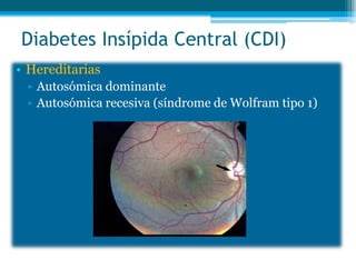 Diabetes Insípida Central (CDI)
• Hereditarias
• Autosómica dominante
• Autosómica recesiva (síndrome de Wolfram tipo 1)
 