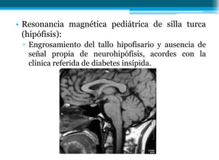 • Resonancia magnética pediátrica de silla turca
(hipófisis):
▫ Engrosamiento del tallo hipofisario y ausencia de
señal propia de neurohipófisis, acordes con la
clínica referida de diabetes insípida.
 