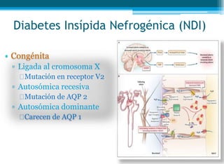 Diabetes Insípida Nefrogénica (NDI)
• Congénita
▫ Ligada al cromosoma X
Mutación en receptor V2
▫ Autosómica recesiva
Mutación de AQP 2
▫ Autosómica dominante
Carecen de AQP 1
 