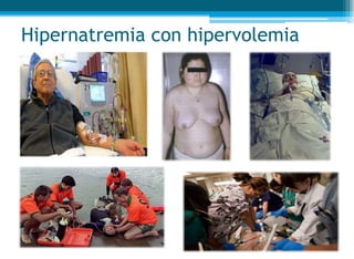 Hipernatremia con hipervolemia
 