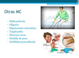 Otras MC
▫ Hidronefrosis
▫ Oliguria
▫ Hipotensión ortostática
▫ Taquicardia
▫ Mucosas secas
▫ Pérdida de peso
▫ Debilidad generalizada
 