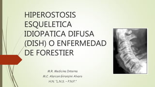 HIPEROSTOSIS
ESQUELETICA
IDIOPATICA DIFUSA
(DISH) O ENFERMEDAD
DE FORESTIER
M.R. Medicina Interna
M.C. Alarcon Gironzini Alvaro
H.N. “L.N.S. – P.N.P.”
 