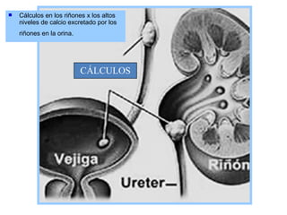 Cálculos en los riñones x los altos niveles de calcio excretado por los riñones en la orina.   CÁLCULOS 
