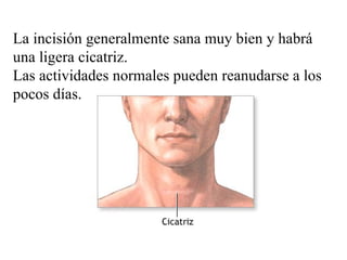 La incisión generalmente sana muy bien y habrá una ligera cicatriz.  Las actividades normales pueden reanudarse a los pocos días.  