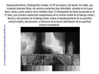 Hiperparatiroidismo. Radiografías simples: A) AP de cadera y B) lateral, de rodilla, que muestran lesiones líticas, de contorno escleroso bien delimitado, situadas en el hueso iliaco, rótula y parte anterior de la metáfisis tibial. C) Radiografía de lesión localizada en el 2º dedo, que muestra reabsorción subperióstica de la cortical medial de la falange media ( flecha) y del penacho de la falange distal; nótese el desdibujamiento de la superficie cortical medial y del penacho, a diferencia de la buena delimitación de la superficie cortical contralateral.  www.conganat.org/7congreso/trabajo.asp?id_tra...   