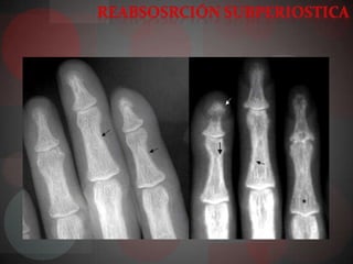 Hiperparatiroidismo