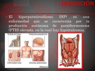  El  hiperparatiroidismo     (HP)    es   una
 enfermedad que se caracteriza por la
 producción autónoma de parathormonona
 (PTH) elevada, en la cual hay hipercalcemia.
 