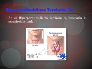 Hiperparatiroidismo Terciario. Tx
 En el Hiperparatiroidismo terciario es necesaria la
 paratiroidectomía.
 