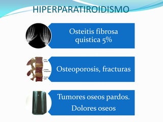 HIPERPARATIROIDISMO
Osteitis fibrosa
quistica 5%
Osteoporosis, fracturas
Tumores oseos pardos.
Dolores oseos
 