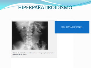 HIPERPARATIROIDISMO
RSA LITIASIS RENAL
 
