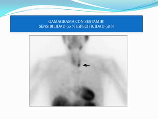GAMAGRAMA CON SESTAMIBI
SENSIBILIDAD 90 % ESPECIFICIDAD 98 %
 