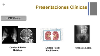 +
Presentaciones Clínicas
HPTP Clásico
Osteítis Fibrosa
Quística.
Litiasis Renal
Recidivante.
Nefrocalcinosis.
 