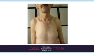 NEJM 2000. Parathyroid disorders
 