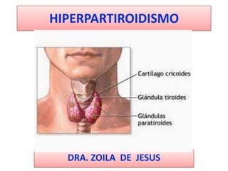 HIPERPARTIROIDISMO




  DRA. ZOILA DE JESUS
 