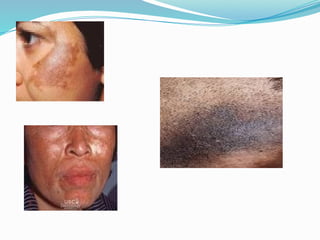 hiperpigmentation dan jenis bercak di wajah.pptx