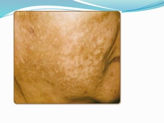 hiperpigmentation dan jenis bercak di wajah.pptx