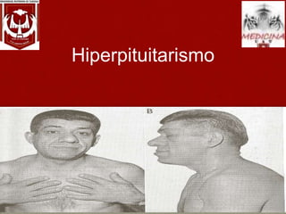 Hiperpituitarismo
 