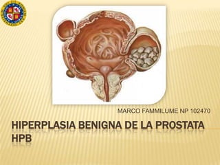 MARCO FAMMILUME NP 102470

HIPERPLASIA BENIGNA DE LA PROSTATA
HPB
 