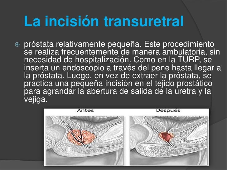 Como aumentar la longitud del miembro en sin operación