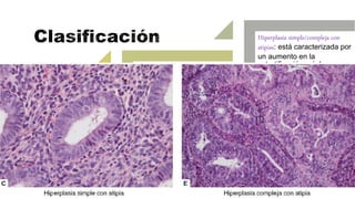Hiperplasia simple: es una
lesión proliferativa que se
caracteriza por cambios
arquitectónicos en las
glándulas de diversos
tamaños, con mínimos
cambios en la complejidad
y densidad glandular y
abundante estroma entre
las mismas.
Hiperplasia compleja: lesión
proliferativa, en la cual se
exhibe un incremento en el
número y tamaño de las
glándulas endometriales,
que lucen apiñadas de
forma irregular y con
mínimo estroma
interpuesto
Hiperplasia simple/compleja con
atipias: está caracterizada por
un aumento en la
estratificación, núcleos
hipercromáticos, nucléolo
prominente, cromatina de
aspecto grumoso e
incremento de la razón
núcleo/citoplasma.
 
