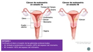 ESTADIO I
Confinado al útero e invasión de las glándulas endocervicales
• IA: limitado al endometrio o invasión <50% del espesor del miometrio.
• IB: Invasión >50% del espesor del miometrio.
 