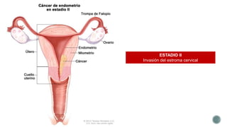 ESTADIO II
Invasión del estroma cervical
 