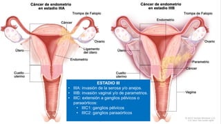ESTADIO III
• IIIA: invasión de la serosa y/o anejos.
• IIIB: invasión vaginal y/o de parametrios.
• IIIC: extensión a ganglios pélvicos o
paraaórticos:
• IIIC1: ganglios pélvicos
• IIIC2: ganglios paraaórticos
 