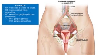 ESTADIO III
• IIIA: invasión de la serosa y/o anejos.
• IIIB: invasión vaginal y/o de
parametrios.
• IIIC: extensión a ganglios pélvicos o
paraaórticos:
• IIIC1: ganglios pélvicos
• IIIC2: ganglios paraaórticos
 