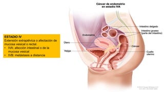 ESTADIO IV
Extensión extrapélvica o afectación de
mucosa vesical o rectal.
• IVA: afección intestinal o de la
mucosa vesical
• IVB: metástasis a distancia
 