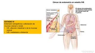 ESTADIO IV
Extensión extrapélvica o afectación de
mucosa vesical o rectal.
• IVA: afección intestinal o de la mucosa
vesical
• IVB: metástasis a distancia
 