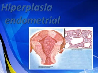Hiperplasia
 endometrial
 