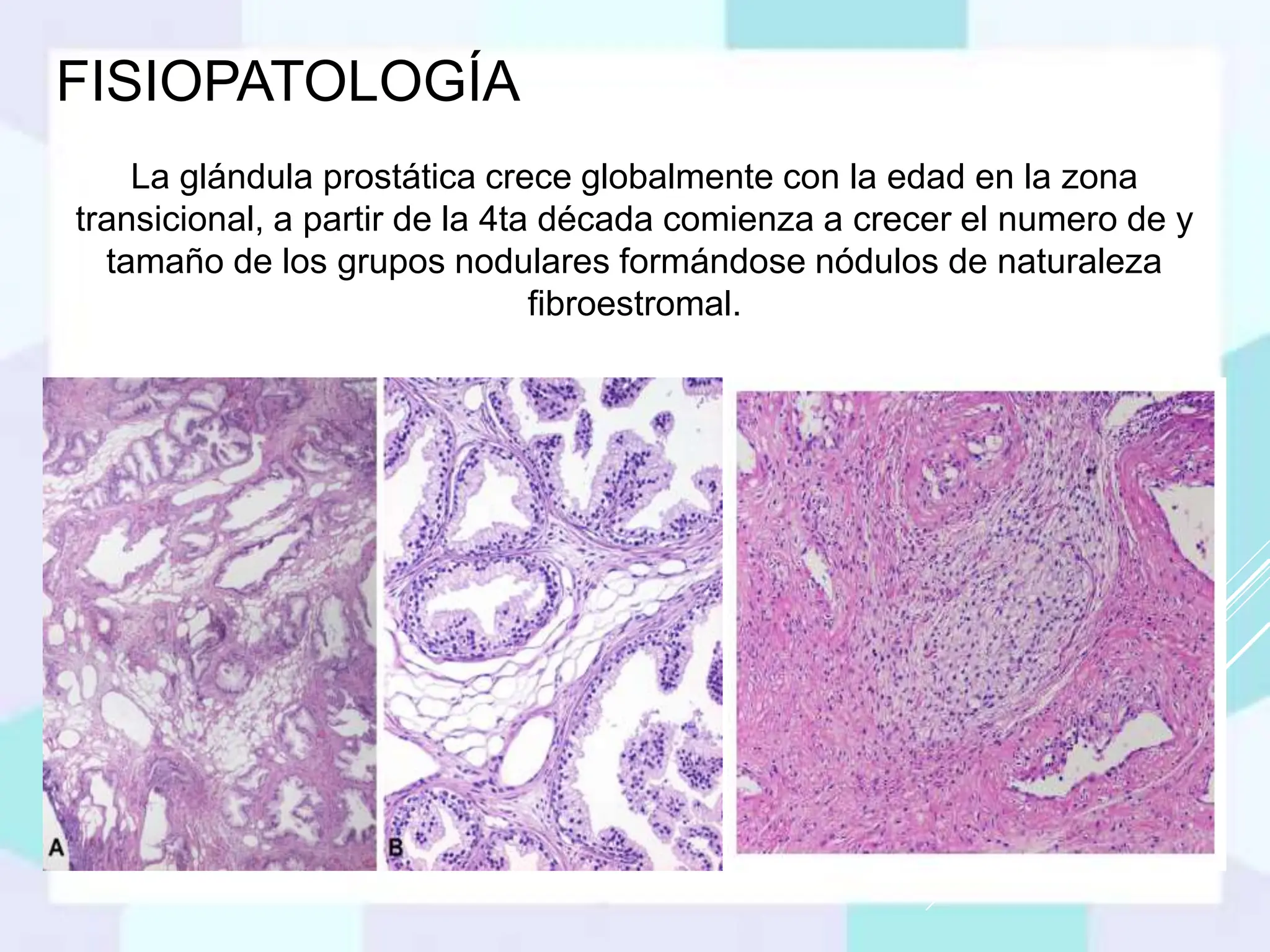 Que es la hiperplasia prostatica benigna.pptx