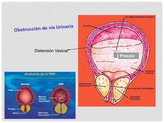 Distensión Vesical
Presión
 
