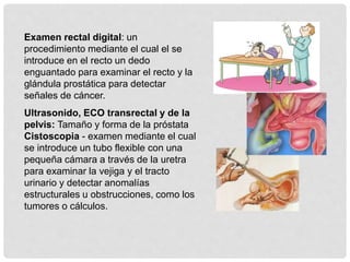 Examen rectal digital: un
procedimiento mediante el cual el se
introduce en el recto un dedo
enguantado para examinar el recto y la
glándula prostática para detectar
señales de cáncer.
Ultrasonido, ECO transrectal y de la
pelvis: Tamaño y forma de la próstata
Cistoscopia - examen mediante el cual
se introduce un tubo flexible con una
pequeña cámara a través de la uretra
para examinar la vejiga y el tracto
urinario y detectar anomalías
estructurales u obstrucciones, como los
tumores o cálculos.
 