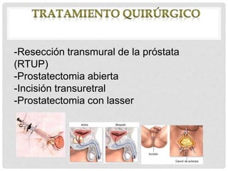 -Resección transmural de la próstata
(RTUP)
-Prostatectomia abierta
-Incisión transuretral
-Prostatectomia con lasser
 