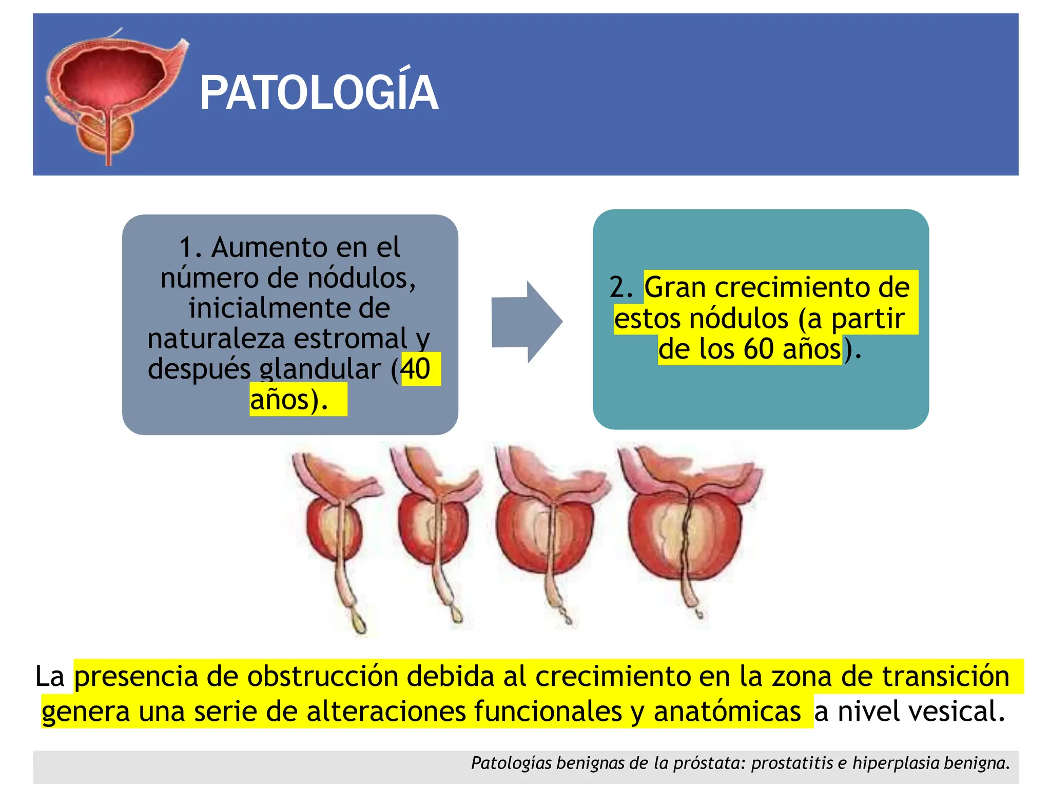HIPERPLASIA PROSTATICA BENIGNA ANATOMÍA DE LA PRÓSTATA | PPTX