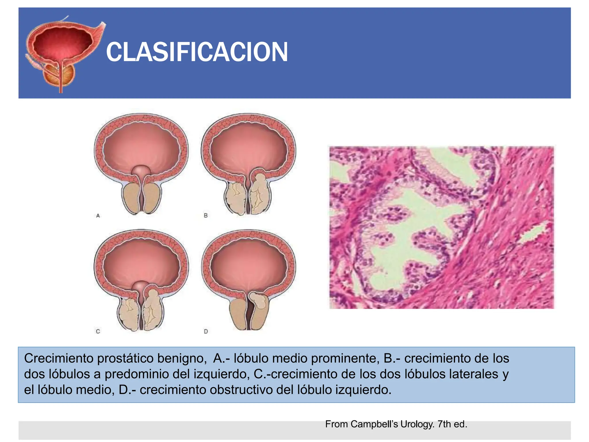 HIPERPLASIA PROSTATICA BENIGNA ANATOMÍA DE LA PRÓSTATA | PPTX