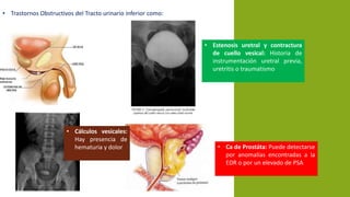 • Trastornos Obstructivos del Tracto urinario inferior como:
• Estenosis uretral y contractura
de cuello vesical: Historia de
instrumentación uretral previa,
uretritis o traumatismo
• Cálculos vesicales:
Hay presencia de
hematuria y dolor • Ca de Prostáta: Puede detectarse
por anomalías encontradas a la
EDR o por un elevado de PSA
 
