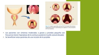 • Los pacientes con síntomas moderados a graves y prostáta pequeña con
frecuencia tienen hiperplasia de la comisura posterior (cuello vesical elevado)
• Se benefician estos pacientes de una incisión de la prostáta
 