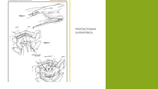 PROSTACTEOMIA
SUPRAPÚBICA
 