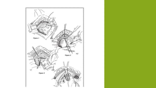 Hiperplasia prostatica benigna