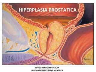 HIPERPLASIA PROSTATICA
RIVELINO SOTO GARCIA
UNIDAD DOCENTE MFyC MENORCA
 