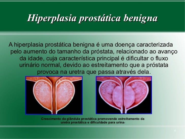 Hiperplasia prostática benigna Hiperplasia prostática benigna